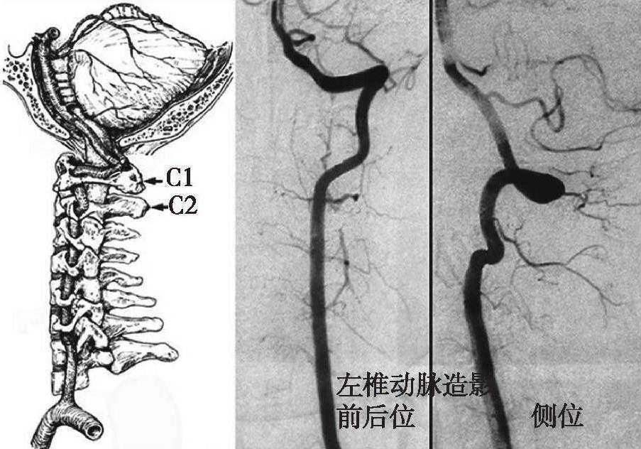 四、椎-基底動脈系統(tǒng)